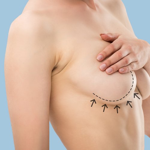 https://www.drsamerbassilios.com/images/services/Breast-Lift.jpg