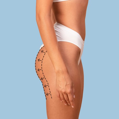 https://www.drsamerbassilios.com/images/services/gluteal-augmentation.jpg