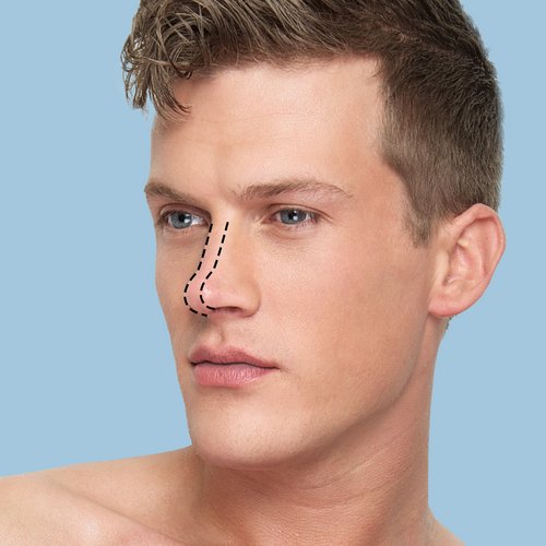 https://www.drsamerbassilios.com/images/services/male-rhinoplasty.jpg