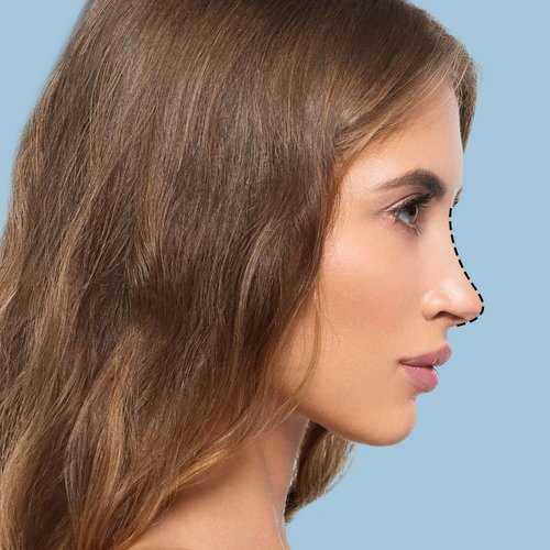 https://www.drsamerbassilios.com/images/services/revision-rhinoplasty.jpg